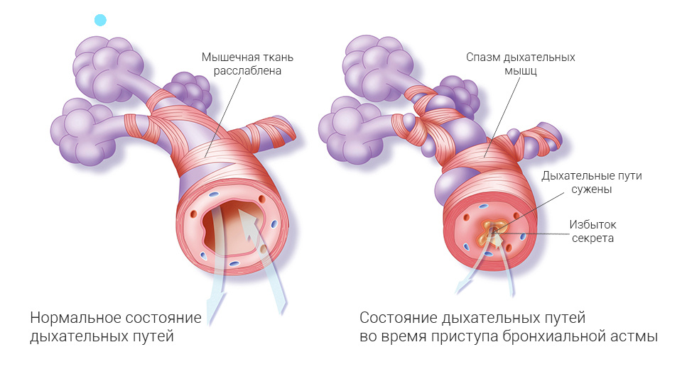 Приступ и симптомы бронхиальной астмы